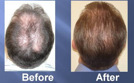 Hair Transplant Radio DJ Mo Foster