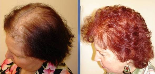 Women Hair Transplant Before and After – Video Testimonial